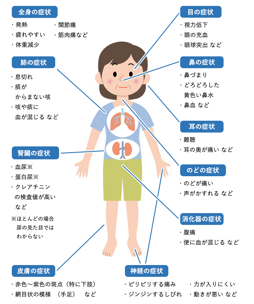 ANCA関連血管炎の症状