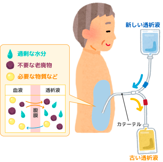 腹膜透析（PD）のしくみ