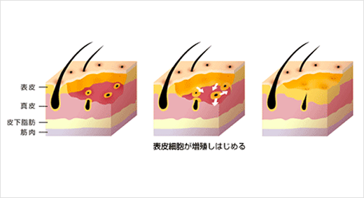 傷 の 治り が 遅い