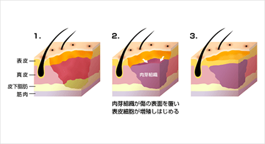 切り傷 ふさがる 時間