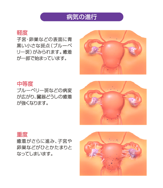 膜 やりすぎ 原因 内 症 子宮