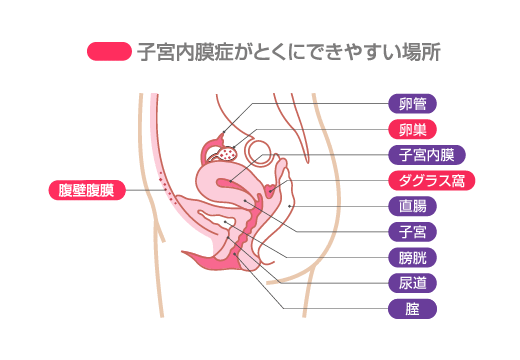 内 症 ストレス 膜 子宮 原因