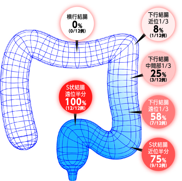 大腸各部位における、フォームの放射能分布割合（症例数）